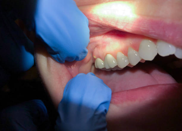 Best Emergency Dentist for Lost Fillings or Crowns in Mars, PA